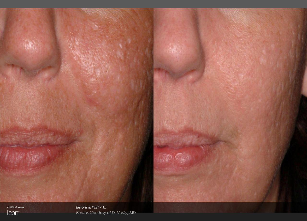 Settlement for facial scar