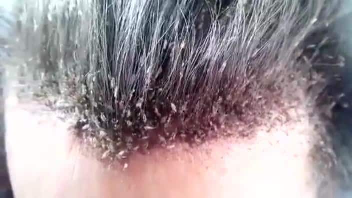 Asian head lice