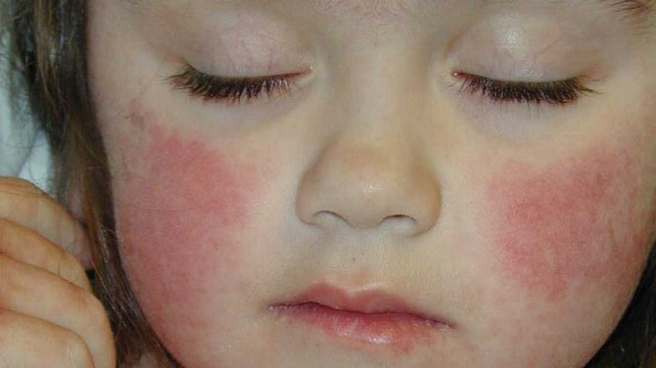 The T. reccomend allergies Facial skin