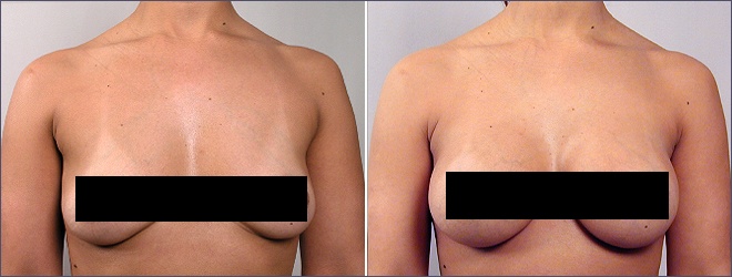 best of Jersey new Breast augmentation