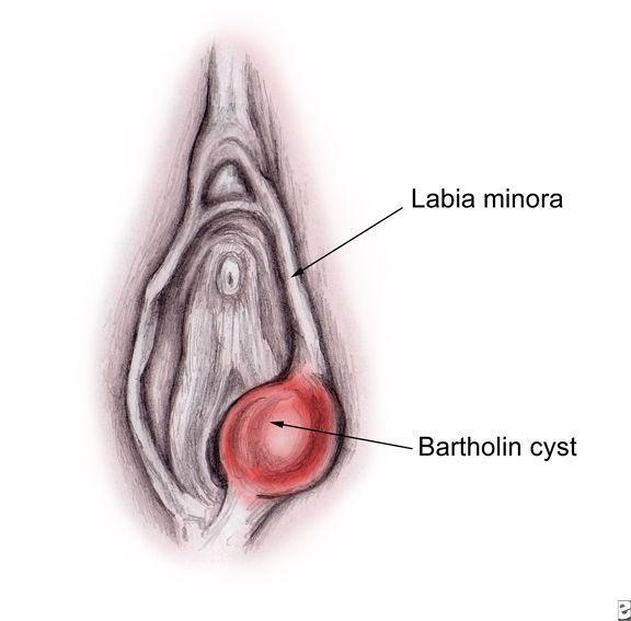 Bump on inner vagina