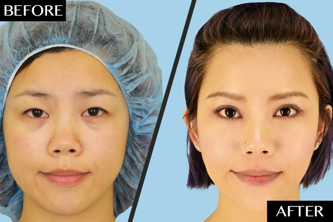 California cosmetic facial surgery