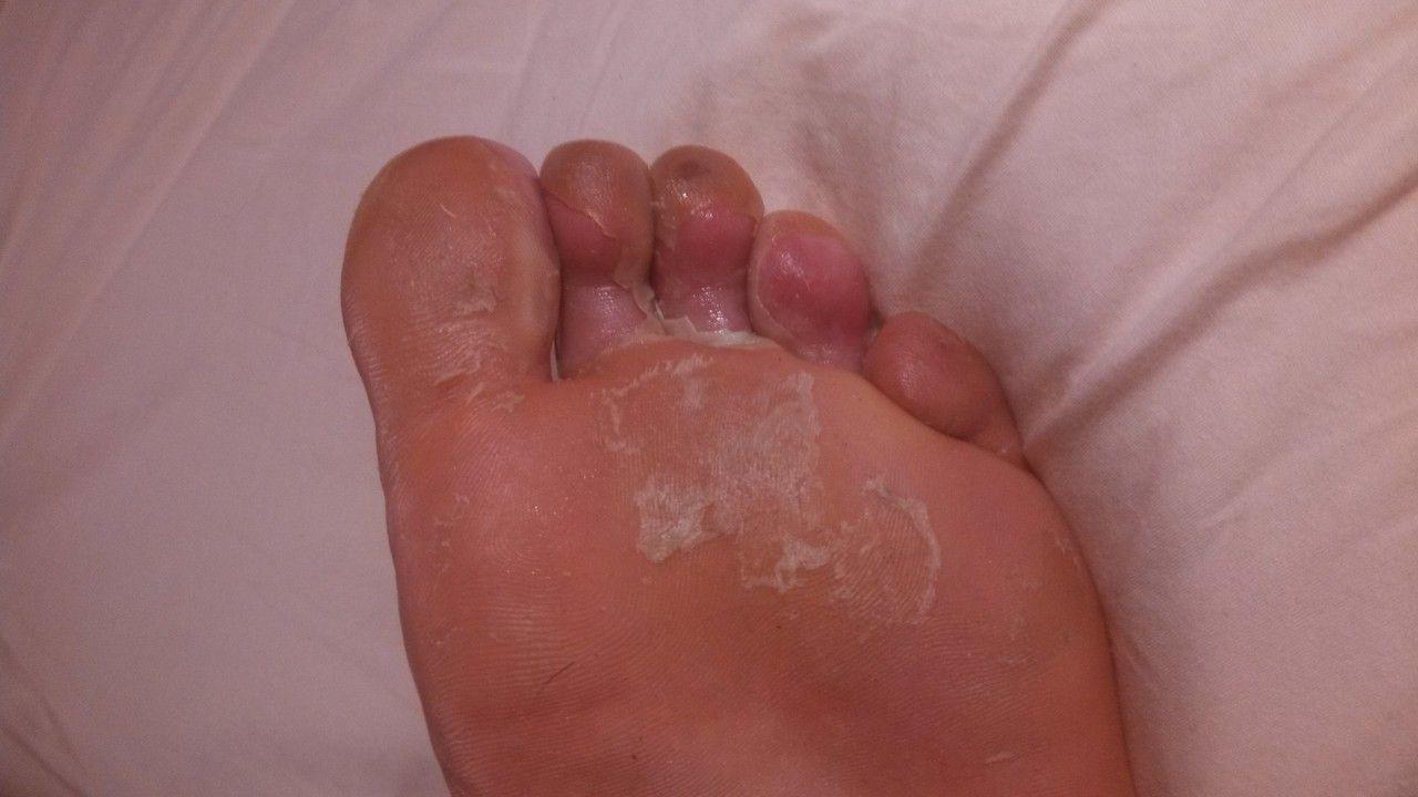 Betty B. reccomend Peeling skin from bottom of foot