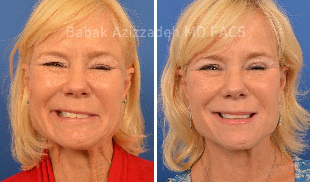 best of Muscle photo facial Cutting