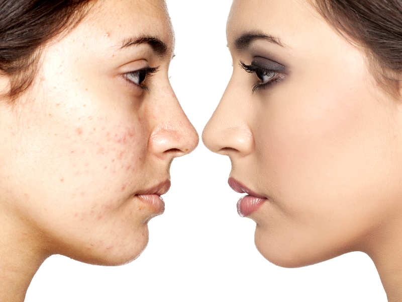 best of Facial permantly Diminish spots