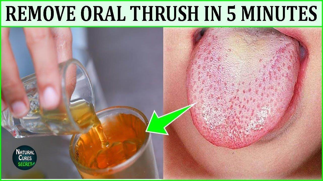 best of The treatment over counter thrush Oral