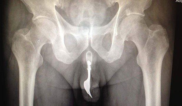 X Ray Penis Penetration