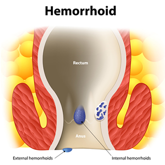 Women with hemorrhoids in public