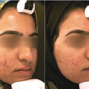 California recomended vulgans dermabrasion acne treatment Facial