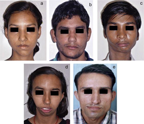 best of Icd-9 Facial asymmetry