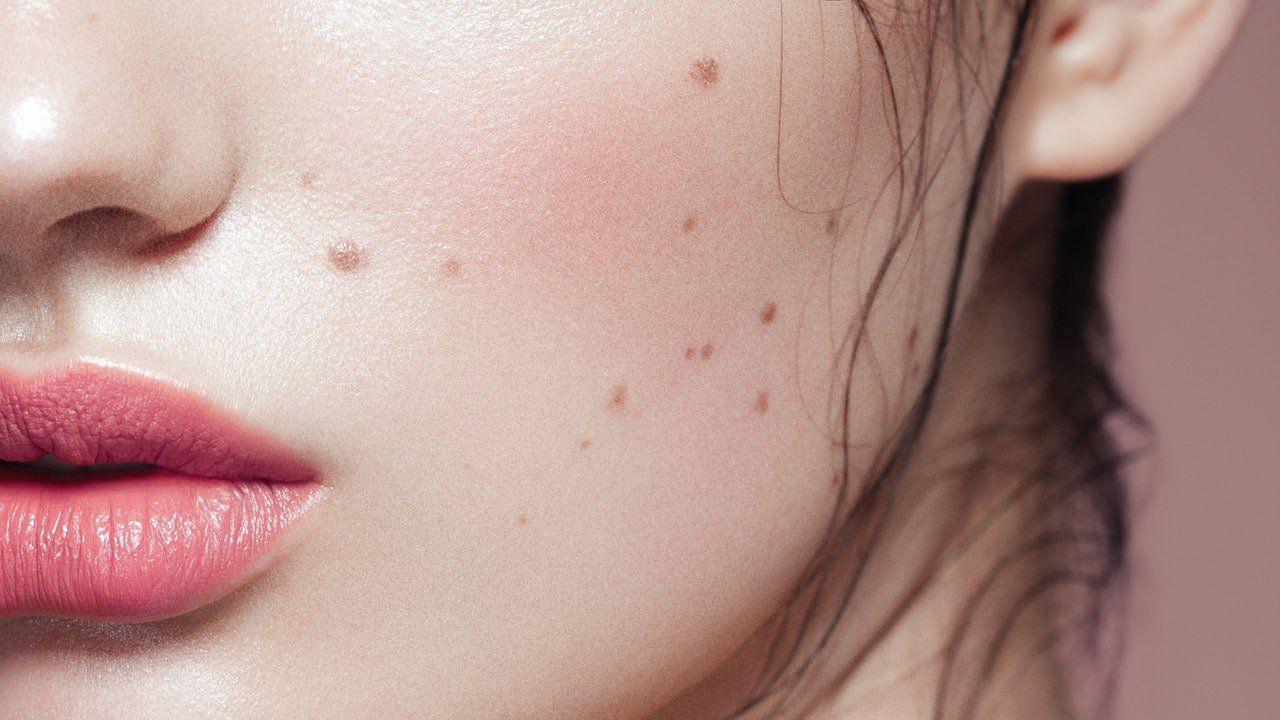 Doppler reccomend Facial beauty marks