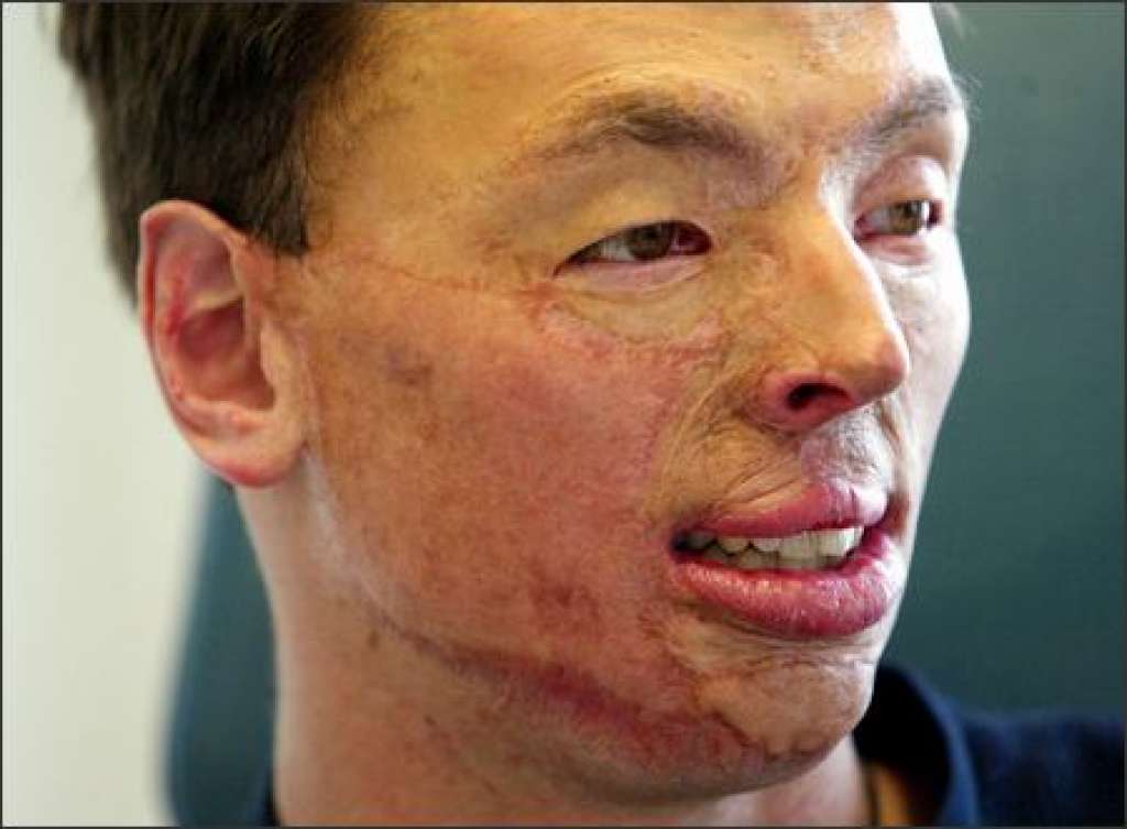 Hydraulics reccomend victim image burn Facial