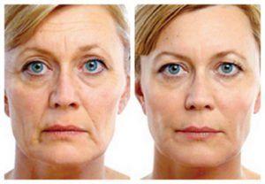 Hydraulics reccomend Facial fillers and pictures