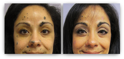 best of Removal procedure mole Facial