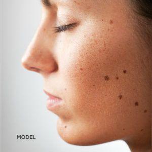 best of Skin moles Facial