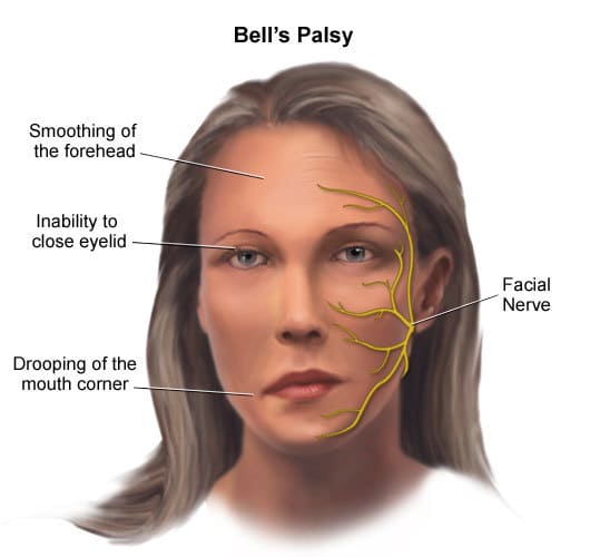 Facial ticks sarcoidosis