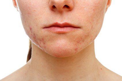 Martian reccomend How to get rid of acne effectively