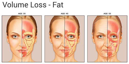 Sundance K. reccomend Ipl facial fat loss photos