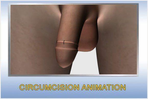 Sugar reccomend Male adult circumcision video