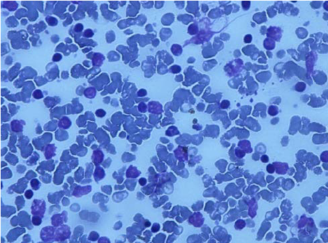 Sherlock recomended lymphocytes cells Mature smudge