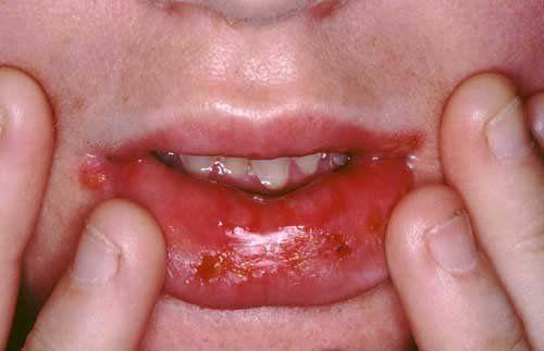 best of Herpes 2 Oral