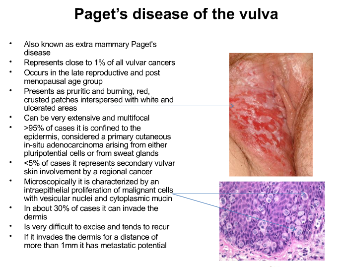 best of Of Padgetts vulva disease