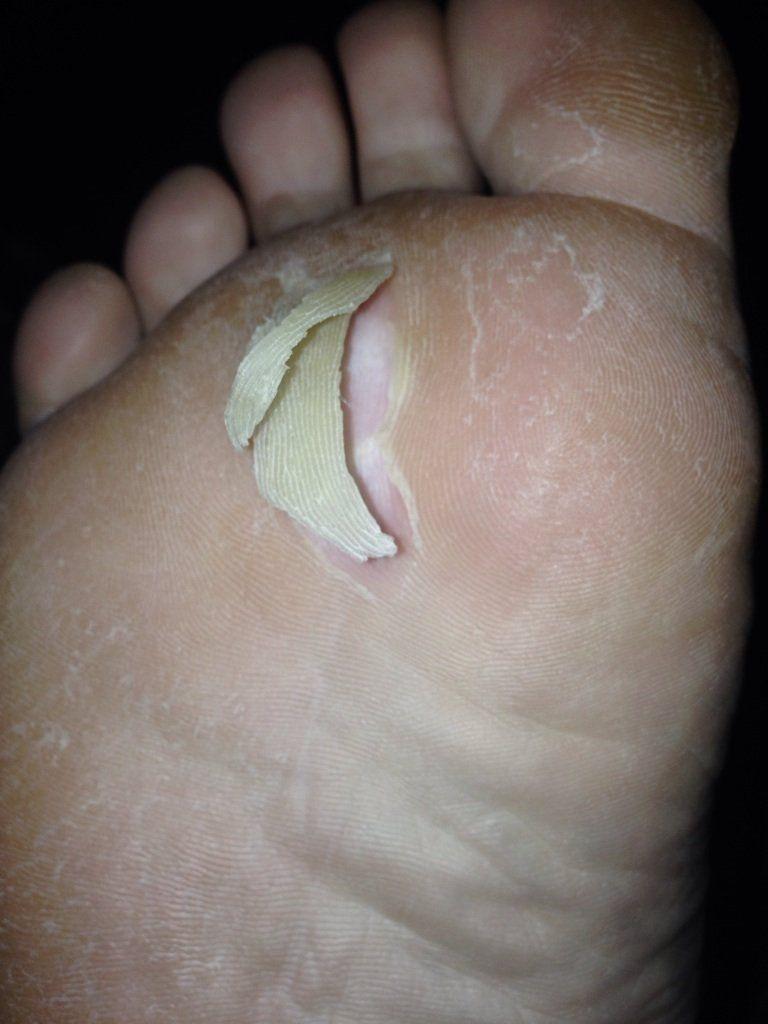 best of Foot of skin Peeling bottom from