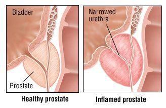 best of Prostatitis with Sexual intercourse