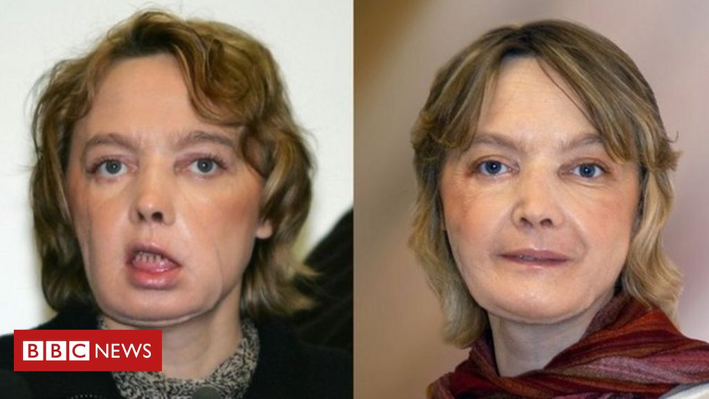 The first facial transplant