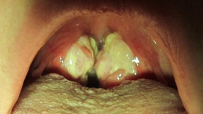 Hog reccomend Treatment for strep adults