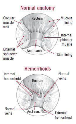 Troubleshoot reccomend Women with hemorrhoids in public